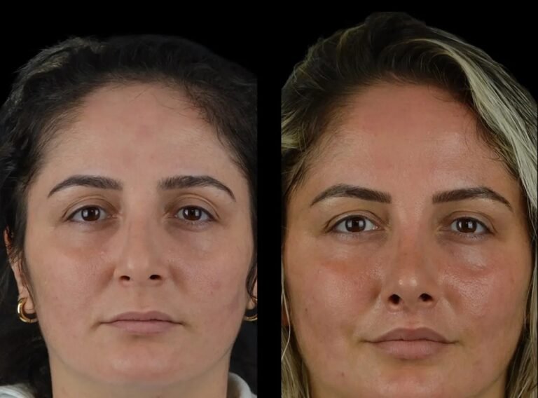 Non-Surgical Face Lifts Using Cheek Fillers by Best Doctors in Dubai