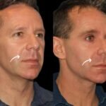 Sculptra Treatment in Dubai Infection Control