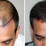 وداعاً للصلع: زراعة الشعر في الرياض… استعد لثقتك المفقودة!