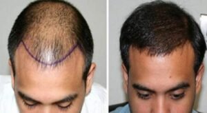 وداعاً للصلع: زراعة الشعر في الرياض… استعد لثقتك المفقودة!