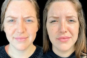 How the Best Doctors in Dubai Ensure Painless Botox Sessions