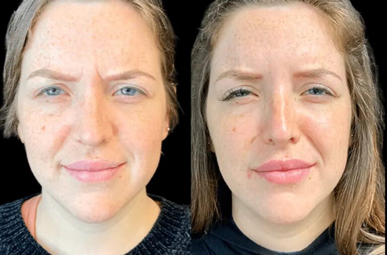 How the Best Doctors in Dubai Ensure Painless Botox Sessions