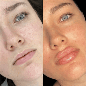 The Most Recommended Best Plastic Surgeons in Dubai for Fillers