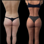 Best Doctors in Dubai for Cutting-Edge J-Plasma Technology