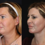 Best Doctors in Dubai Providing Non-Invasive Skin Tightening Solutions