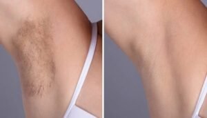 Best Plastic Surgeon in dubai: How Many Laser Hair Removal Sessions Are Needed?
