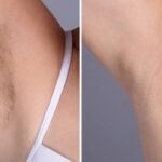 Best Plastic Surgeons in dubai Specializing in Laser Hair Removal