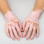 Safe & Trusted Vitiligo Treatment Clinics in Islamabad