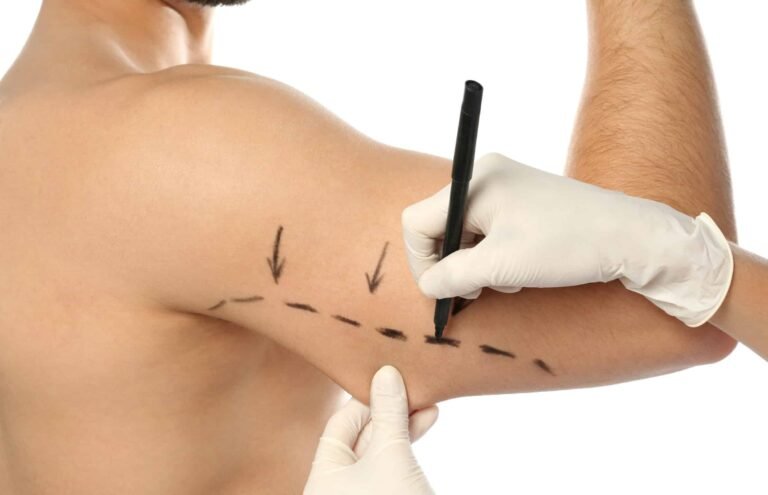 Arm Lift: A Fresh Look for Your Arms