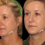 Best Plastic Surgeon in Dubai Sculptra for Jaw Bounce