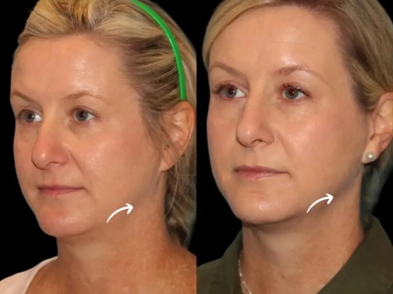 Best Plastic Surgeon in Dubai Sculptra for Jaw Bounce