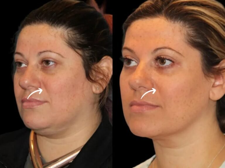 Best Plastic Surgeon in Dubai Uses Sculptra for Skin Legacy