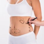 Best Liposuction Surgeons in Dubai for High Definition Body Contouring