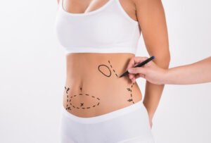 Best Liposuction Surgeons in Dubai for High Definition Body Contouring