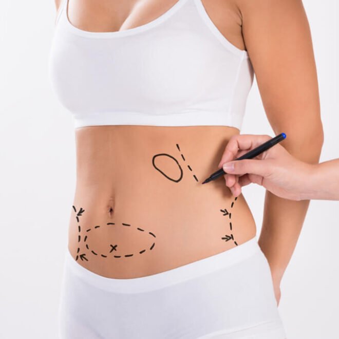 Best Liposuction Surgeons in Dubai for High Definition Body Contouring
