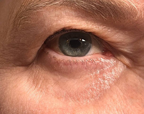 Eyelid Surgery in Islamabad: Subtle Enhancement for Brighter Eyes