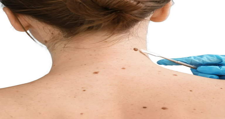 Mole Removal in Dubai: Safe Solutions for Confident Skin