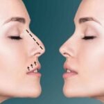 Natural-Looking Nose Jobs: The Riyadh Standard