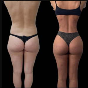 J-Plasma Skin Tightening Solutions by the Best Plastic Surgeon in Dubai