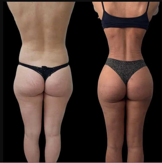 J-Plasma Skin Tightening Solutions by the Best Plastic Surgeon in Dubai