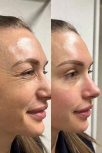 Botox in Islamabad – Botox for Smile Lines: How It Works and Benefits