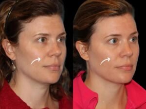 Sculptra for Collagen Deficiency Treatments by Best Doctors in Dubai