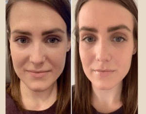 Best Doctors in Dubai Redefining Non-Surgical PRP Treatment