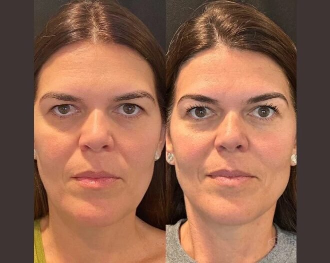 Thread lift Treatment in Dubai for Double Chin Reduction