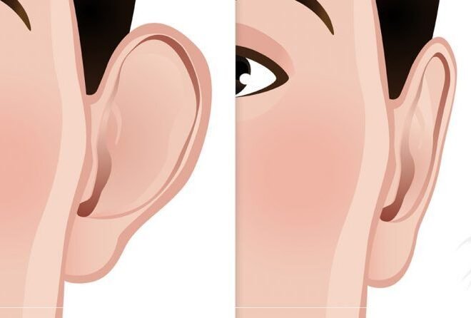 Ear Reshaping in Islamabad: Achieve Natural-Looking Ears