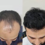 Hair Transplant in Islamabad: Effective and Permanent Hair Restoration