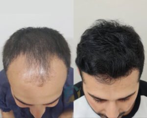 Hair Transplant in Islamabad: Effective and Permanent Hair Restoration
