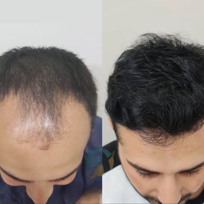 Hair Transplant in Islamabad: Effective and Permanent Hair Restoration