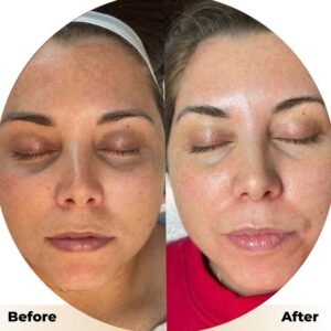 Hydrafacial in Islamabad: Advanced Skincare for Radiant Skin