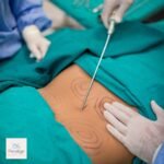 Liposuction in Islamabad – Sculpt Your Body with Expert Care