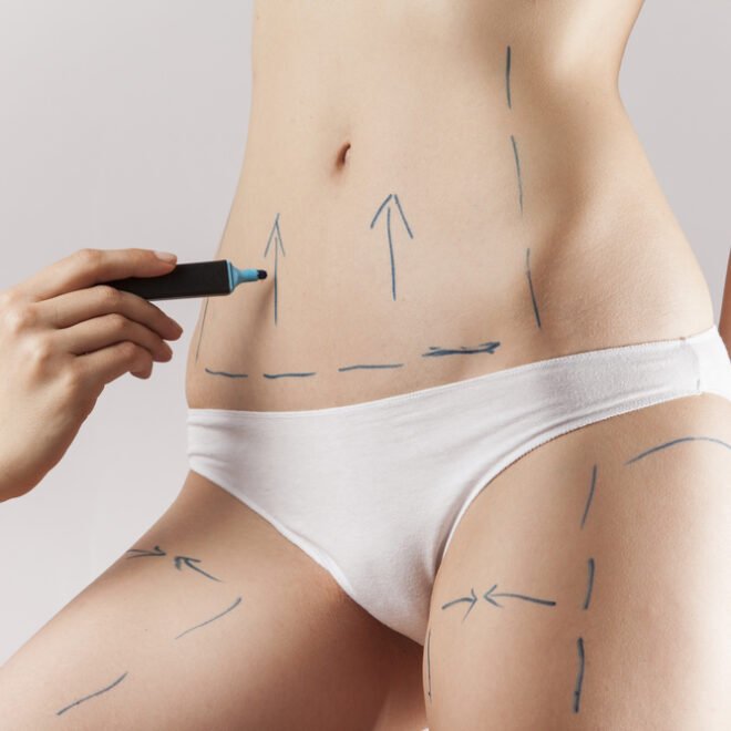 The Role of Technology in Liposuction in Islamabad Procedures