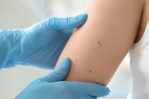 Mole Removal in Islamabad and Addressing Multiple Moles in One Session