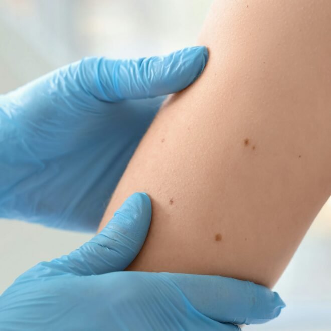 Mole Removal in Islamabad and Addressing Multiple Moles in One Session
