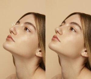 How Rhinoplasty in Islamabad Contributes to a Harmonious Facial Profile