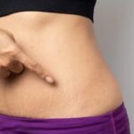 Stretch Mark Removal in Islamabad and Dermal Fibers Rebuilding Science