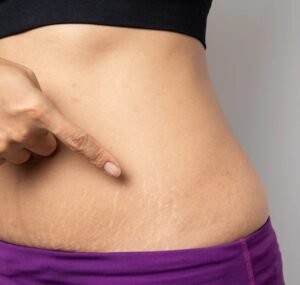 Stretch Mark Removal in Islamabad and Dermal Fibers Rebuilding Science