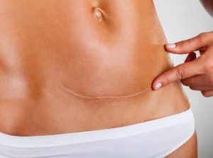 Erase Scars with Post-Surgical Treatment in Abu Dhabi