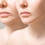 How Often to Touch-Up Dermal Fillers