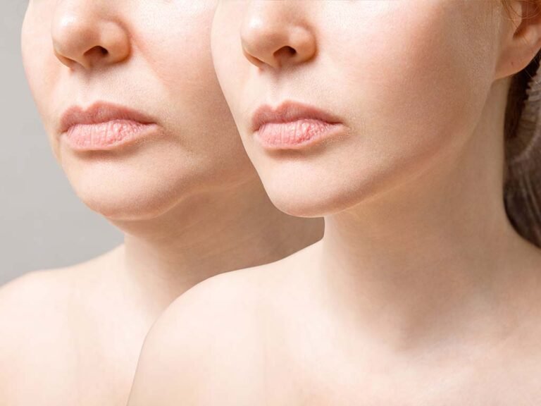How Often to Touch-Up Dermal Fillers