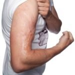 Emotional and Psychological Benefits of Burn Reconstructive Surgery