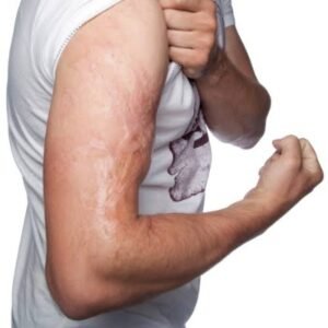 Emotional and Psychological Benefits of Burn Reconstructive Surgery