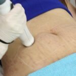 Stretch Mark Removal in Islamabad and the Importance of Skin Remodeling Processes