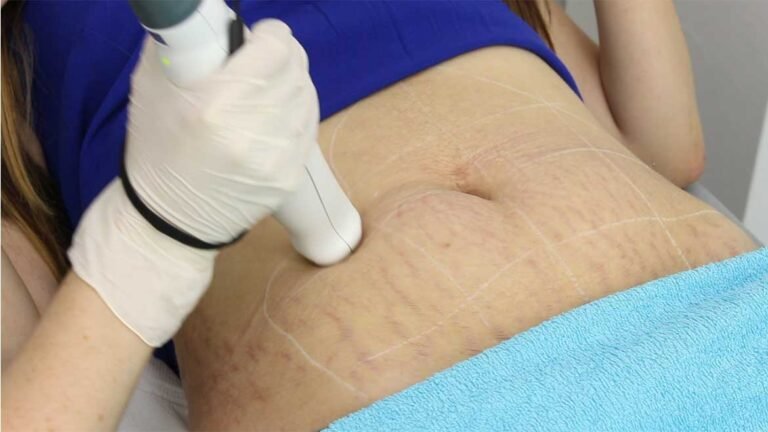 Stretch Mark Removal in Islamabad and the Importance of Skin Remodeling Processes