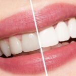 Is Teeth Whitening Suitable for Everyone?