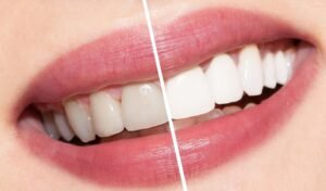 Is Teeth Whitening Suitable for Everyone?