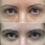 Eyebrow Transplant Dubai – Restore Fuller, Natural-Looking Eyebrows with Advanced Hair Restoration